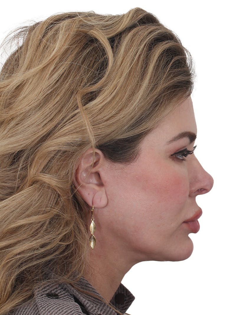 Facelift/Neck Lift Before & After Gallery - Patient 253691 - Image 4