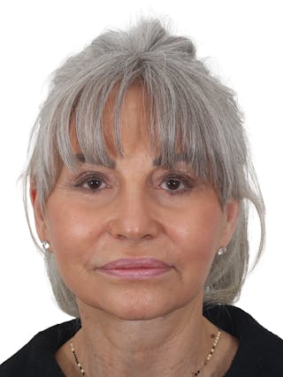 Facelift/Neck Lift Before & After Gallery - Patient 115435 - Image 6