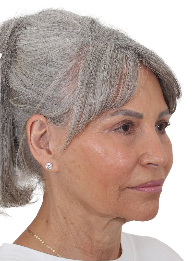 Facelift/Neck Lift Before & After Gallery - Patient 115435 - Image 3