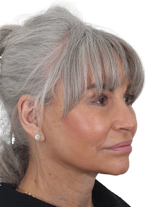 Facelift/Neck Lift Before & After Gallery - Patient 115435 - Image 4