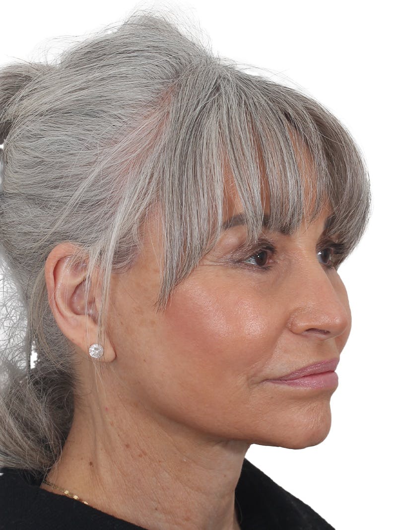Facelift/Neck Lift Before & After Gallery - Patient 115435 - Image 4