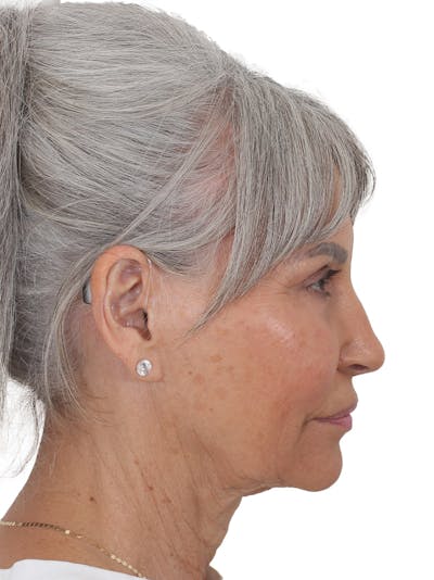 Facelift/Neck Lift Before & After Gallery - Patient 115435 - Image 1