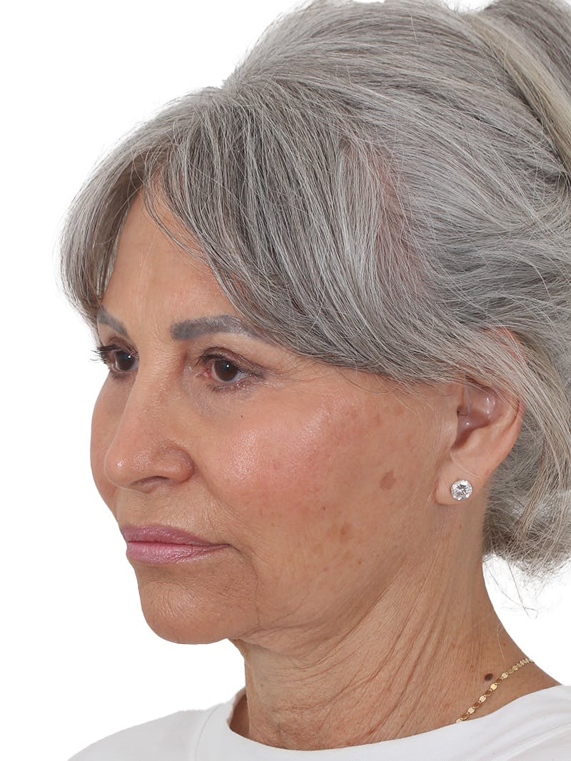 Facelift/Neck Lift Before & After Gallery - Patient 115435 - Image 7