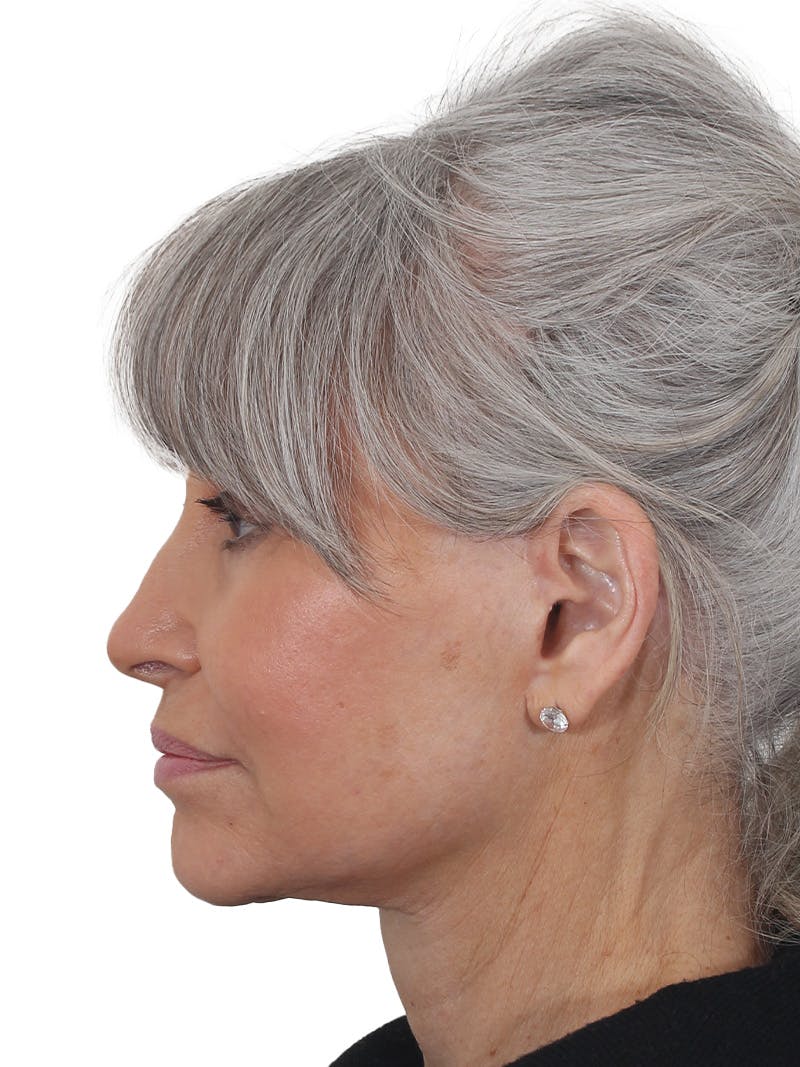 Facelift/Neck Lift Before & After Gallery - Patient 115435 - Image 10