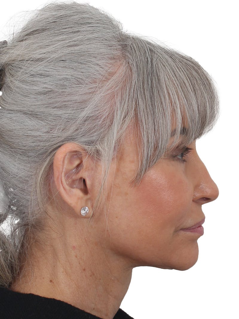 Facelift/Neck Lift Before & After Gallery - Patient 115435 - Image 2