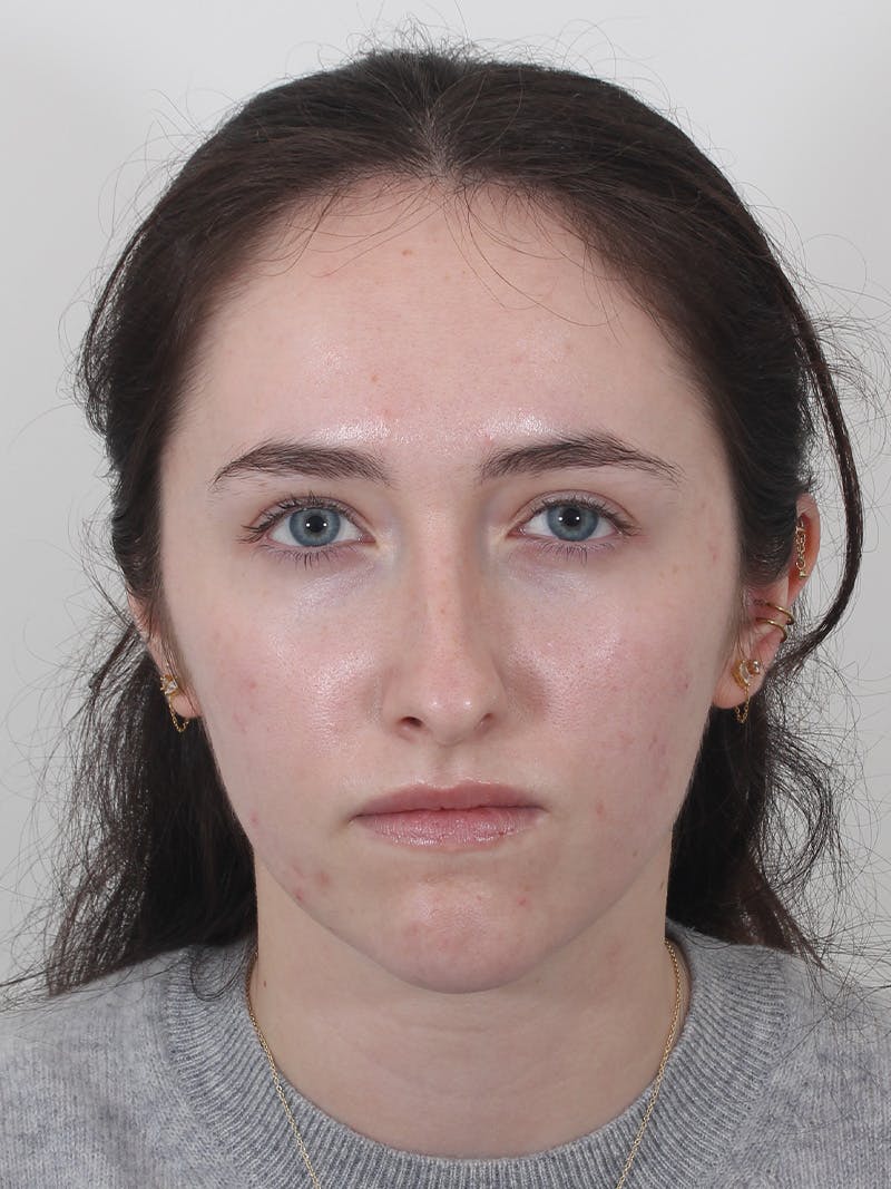 Rhinoplasty Before & After Gallery - Patient 337028 - Image 5