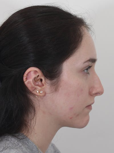 Rhinoplasty Before & After Gallery - Patient 337028 - Image 1