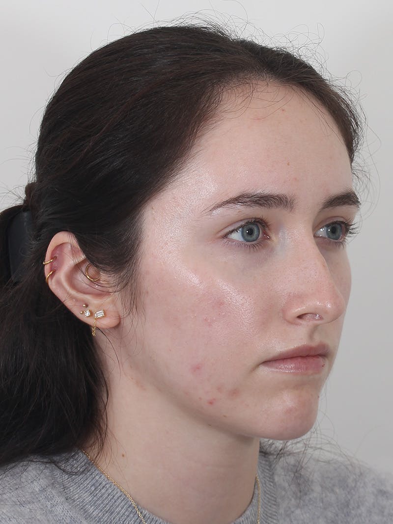 Rhinoplasty Before & After Gallery - Patient 337028 - Image 3