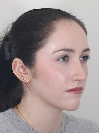 Rhinoplasty Before & After Gallery - Patient 337028 - Image 4