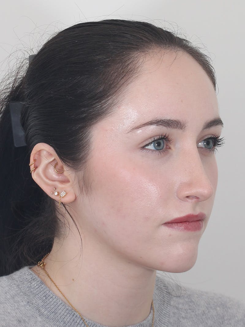 Rhinoplasty Before & After Gallery - Patient 337028 - Image 4