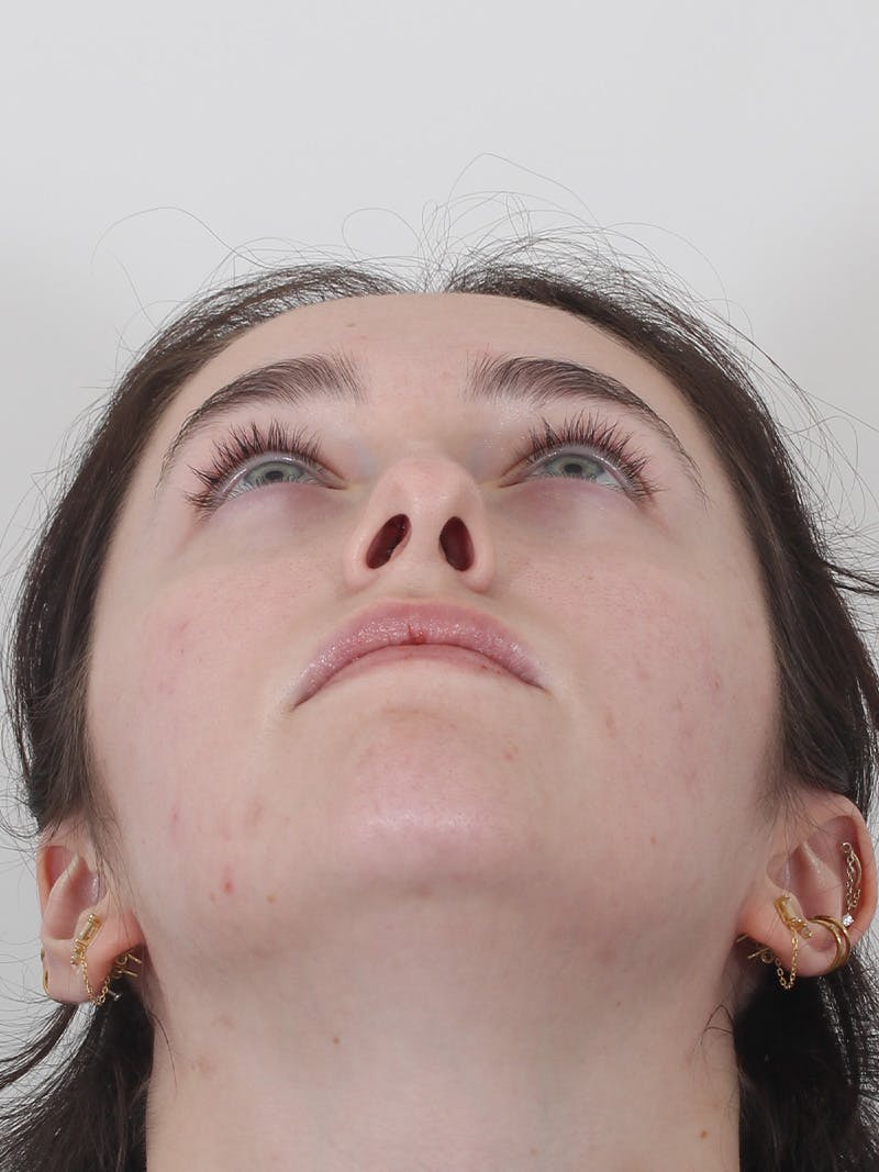 Rhinoplasty Before & After Gallery - Patient 337028 - Image 7