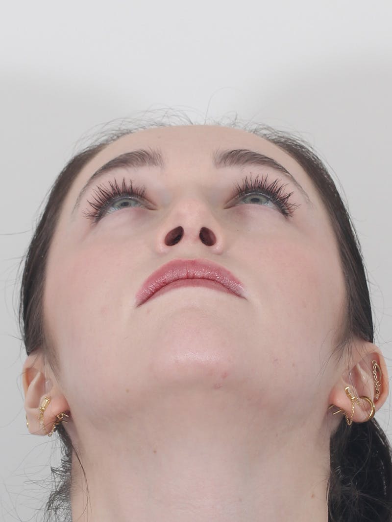 Rhinoplasty Before & After Gallery - Patient 337028 - Image 8