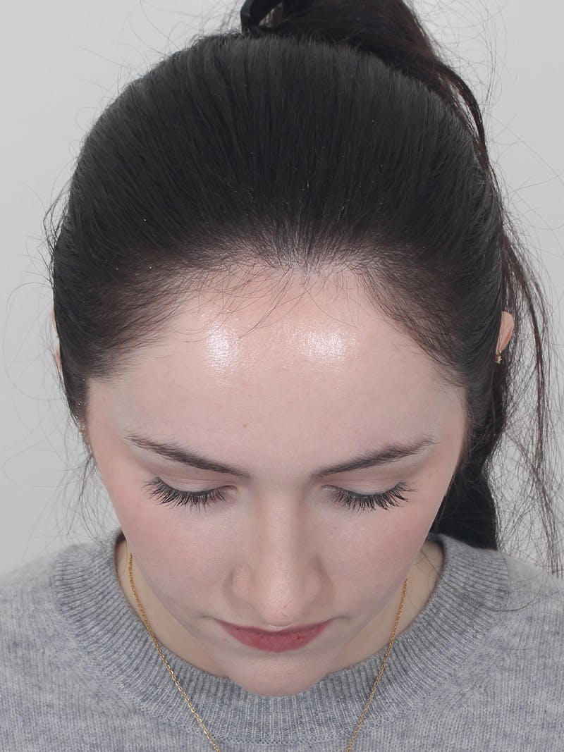 Rhinoplasty Before & After Gallery - Patient 337028 - Image 10