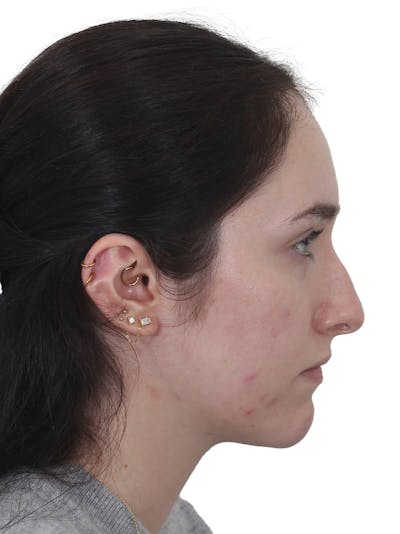 Rhinoplasty Before & After Gallery - Patient 337028 - Image 1