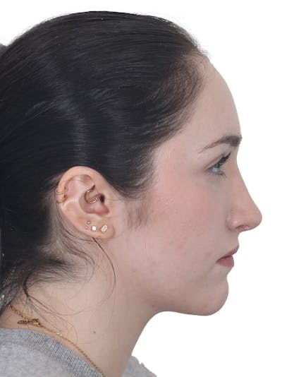 Rhinoplasty Before & After Gallery - Patient 337028 - Image 2