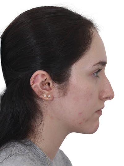 Rhinoplasty Before & After Gallery - Patient 337028 - Image 1