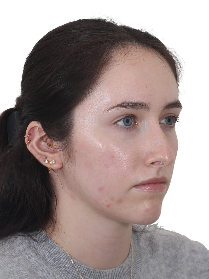 Rhinoplasty Before & After Gallery - Patient 337028 - Image 3