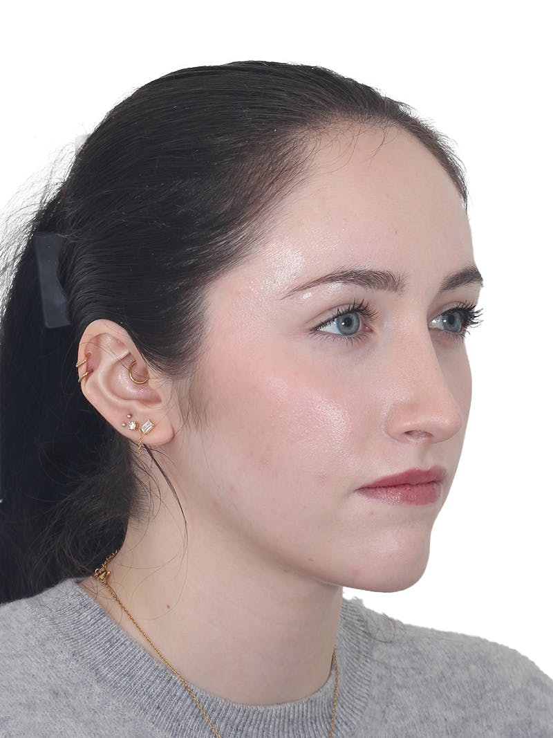 Rhinoplasty Before & After Gallery - Patient 337028 - Image 4