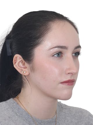 Rhinoplasty Before & After Gallery - Patient 337028 - Image 4