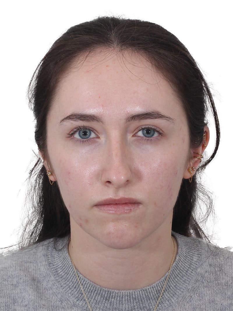 Rhinoplasty Before & After Gallery - Patient 337028 - Image 5