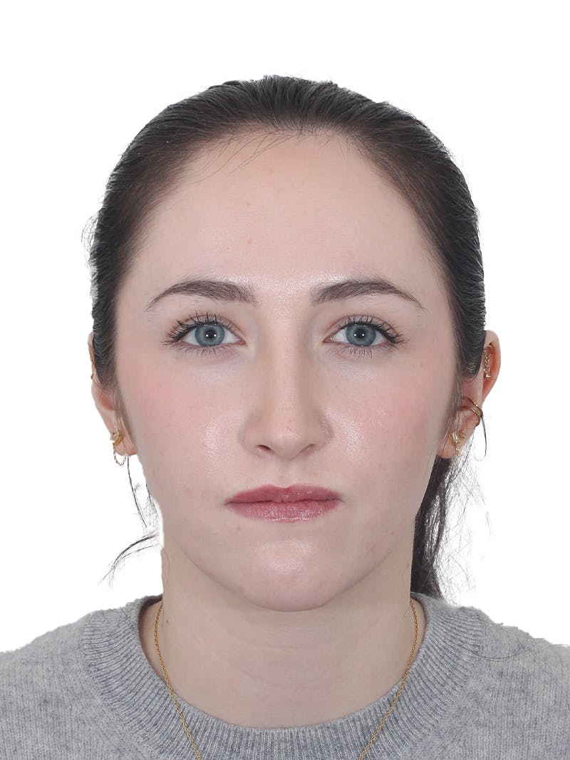 Rhinoplasty Before & After Gallery - Patient 337028 - Image 6