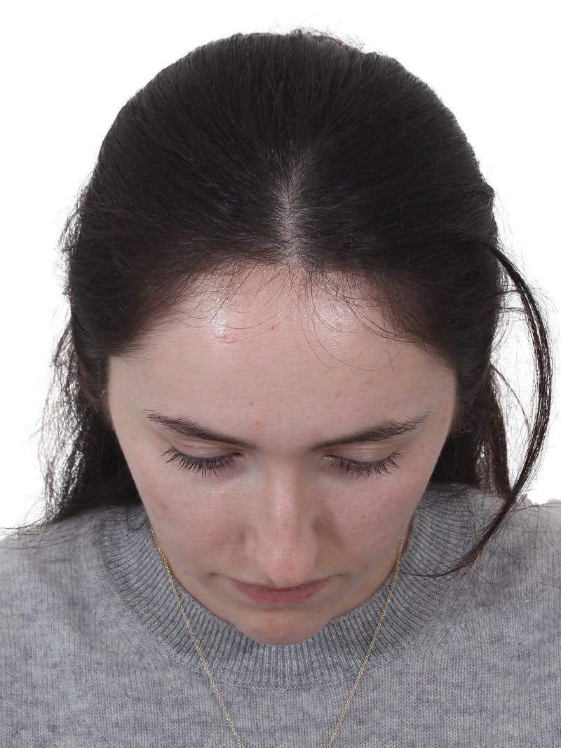 Rhinoplasty Before & After Gallery - Patient 337028 - Image 9