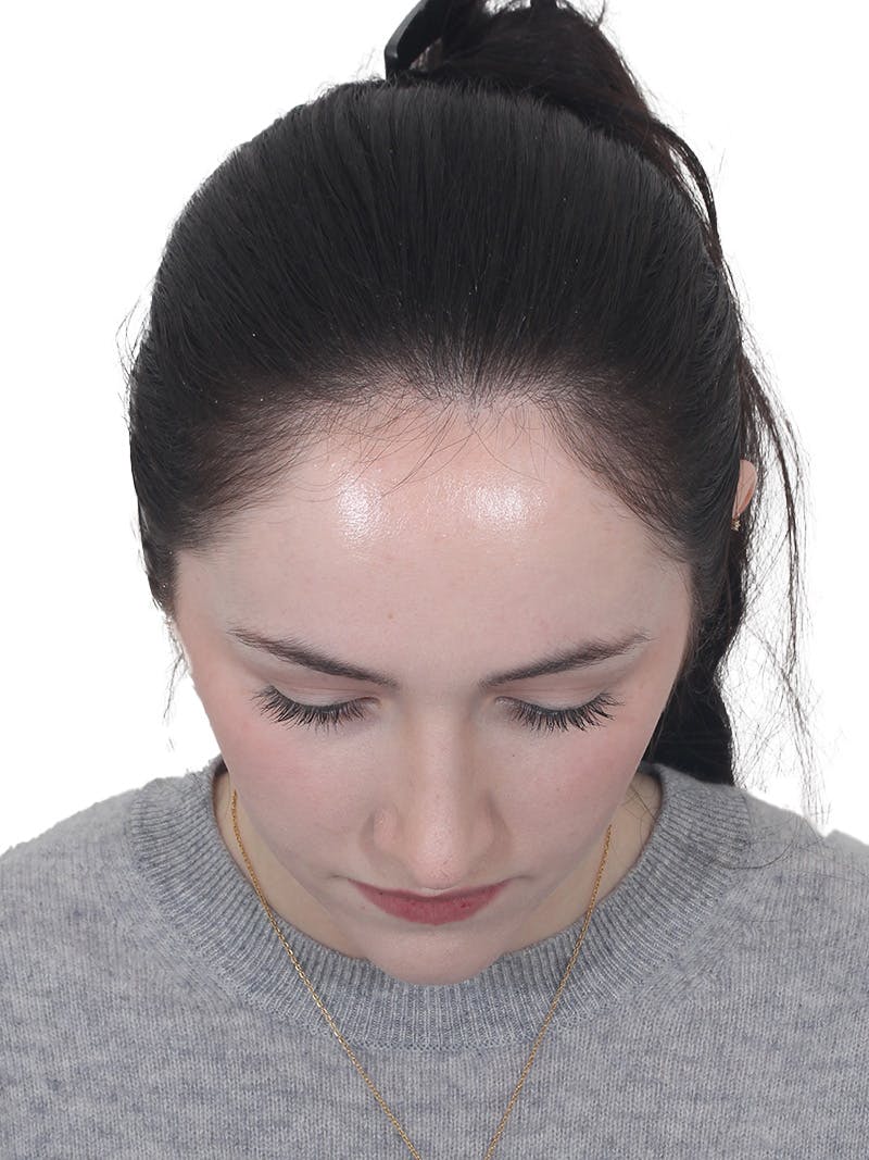 Rhinoplasty Before & After Gallery - Patient 337028 - Image 10