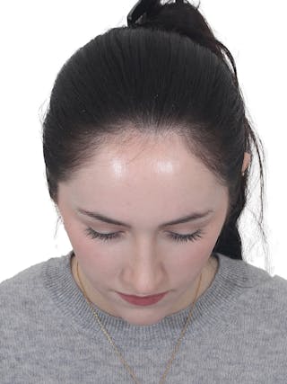 Rhinoplasty Before & After Gallery - Patient 337028 - Image 10