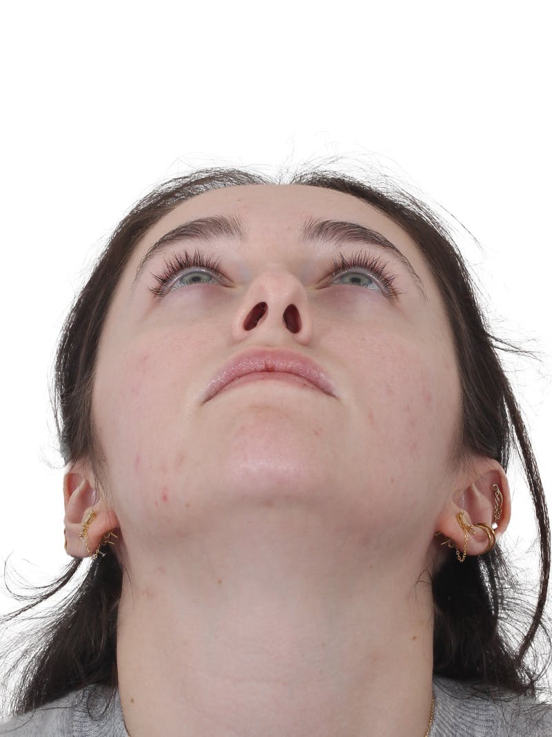 Rhinoplasty Before & After Gallery - Patient 337028 - Image 7