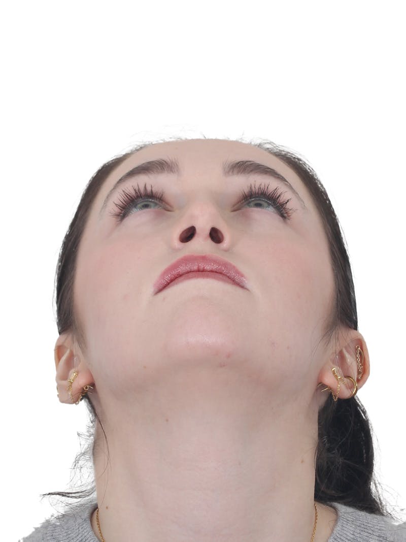 Rhinoplasty Before & After Gallery - Patient 337028 - Image 8