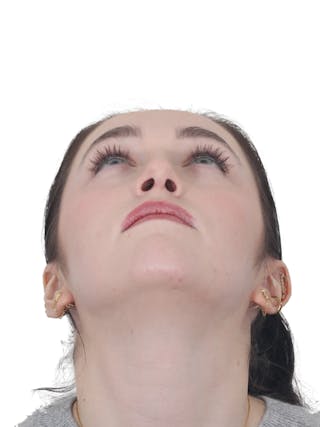Rhinoplasty Before & After Gallery - Patient 337028 - Image 8