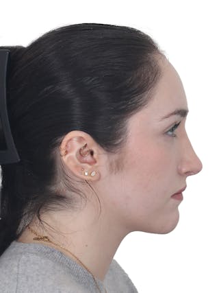 Rhinoplasty Before & After Gallery - Patient 337028 - Image 2