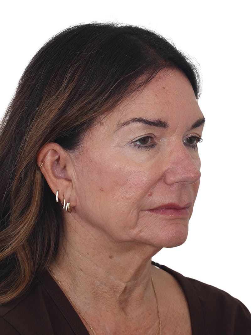 Facelift/Neck Lift Before & After Gallery - Patient 941383 - Image 3