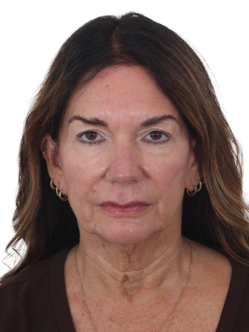 Facelift/Neck Lift Before & After Gallery - Patient 941383 - Image 1