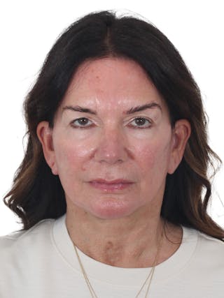 Facelift/Neck Lift Before & After Gallery - Patient 941383 - Image 2