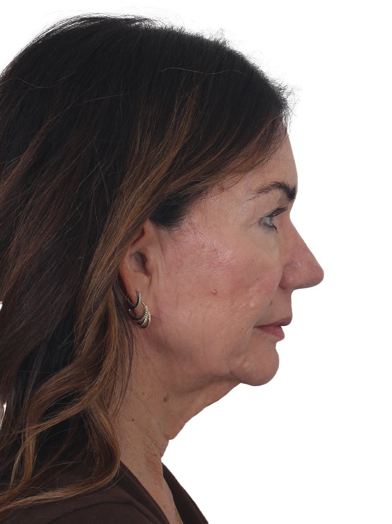Facelift/Neck Lift Before & After Gallery - Patient 941383 - Image 5