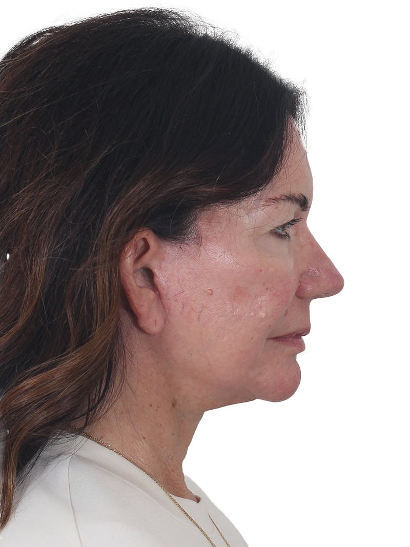 Facelift/Neck Lift Before & After Gallery - Patient 941383 - Image 6