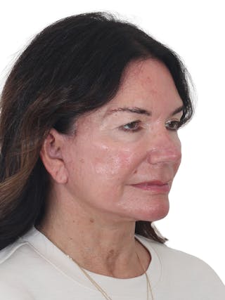 Facelift/Neck Lift Before & After Gallery - Patient 941383 - Image 4