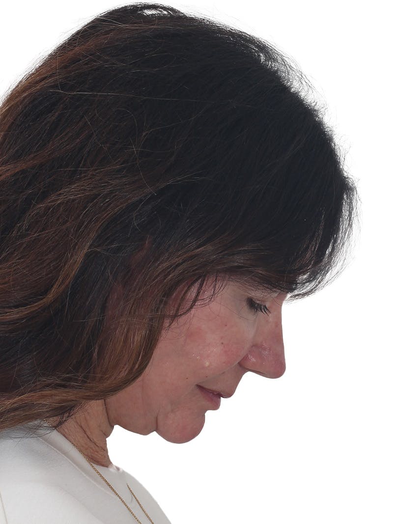 Facelift/Neck Lift Before & After Gallery - Patient 941383 - Image 8