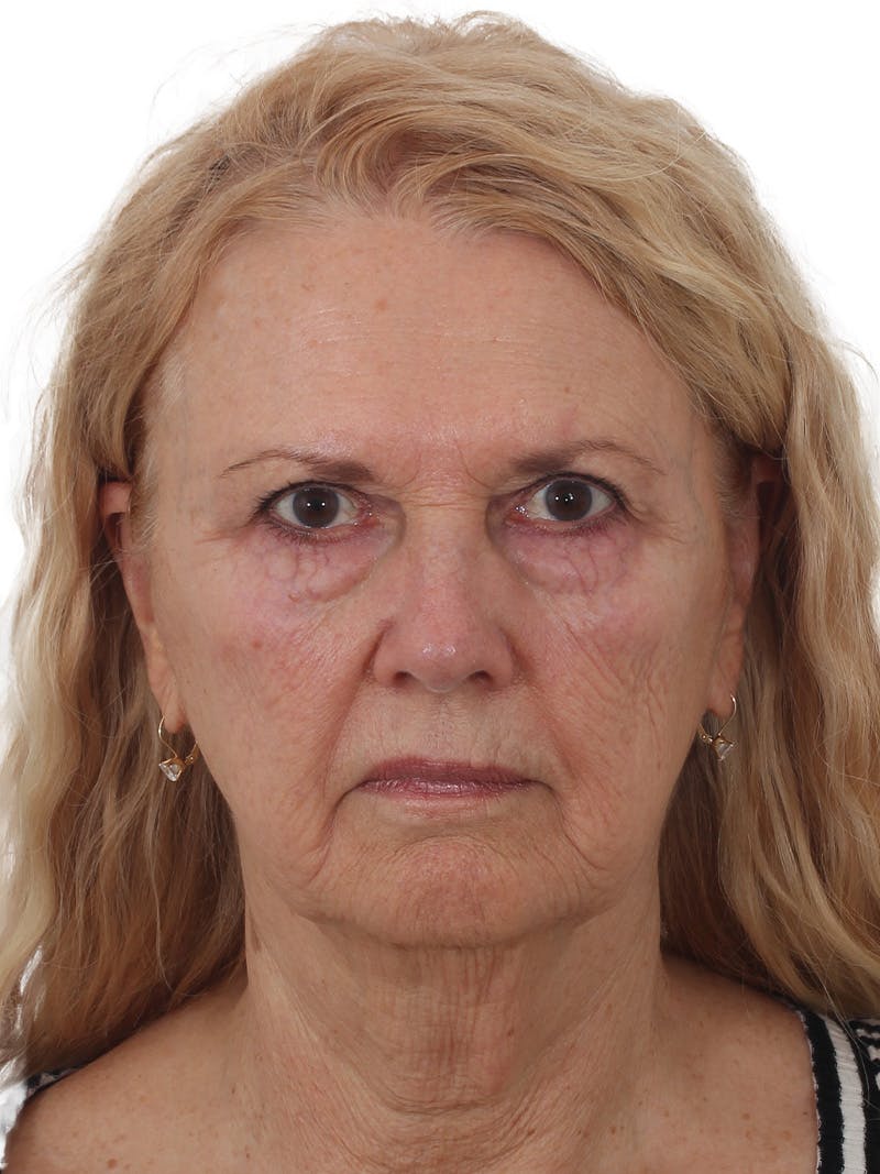 Facelift/Neck Lift Before & After Gallery - Patient 208306 - Image 1