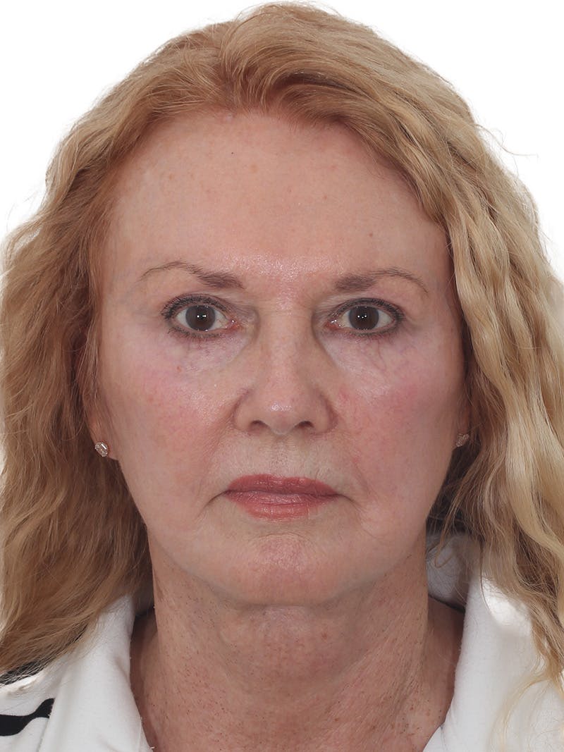 Facelift/Neck Lift Before & After Gallery - Patient 208306 - Image 2