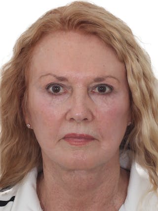 Blepharoplasty Before & After Gallery - Patient 114654 - Image 2