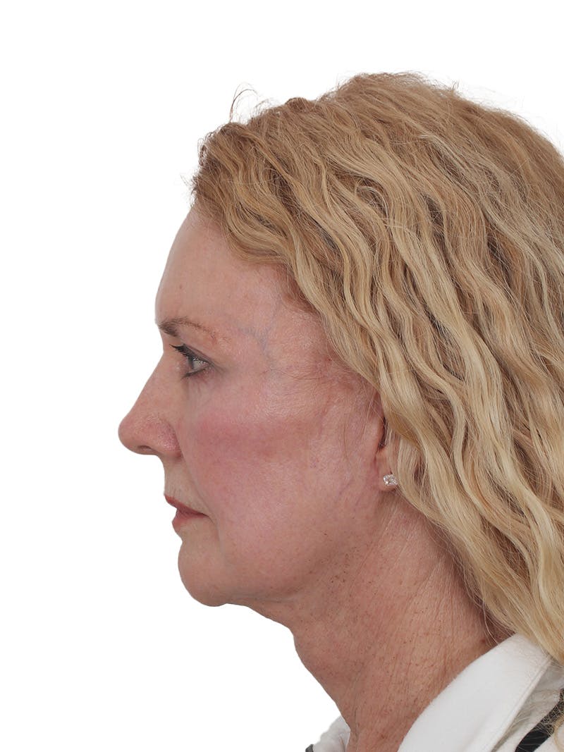 Facelift/Neck Lift Before & After Gallery - Patient 208306 - Image 6