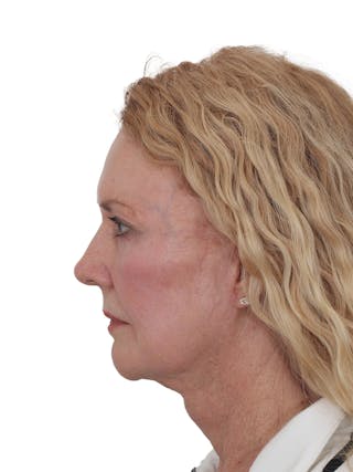 Blepharoplasty Before & After Gallery - Patient 114654 - Image 6