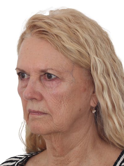 Earlobe Repair Before & After Gallery - Patient 236757 - Image 1