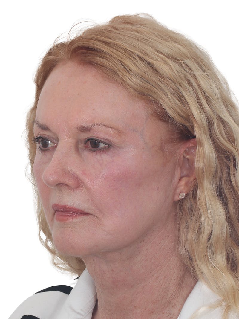 Facelift/Neck Lift Before & After Gallery - Patient 208306 - Image 4