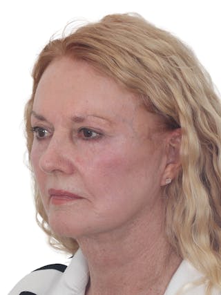 Blepharoplasty Before & After Gallery - Patient 114654 - Image 4