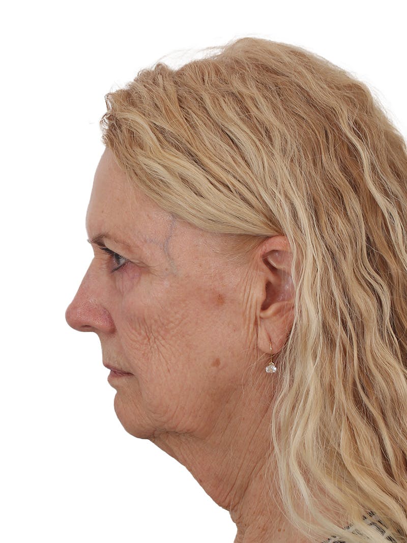 Facelift/Neck Lift Before & After Gallery - Patient 208306 - Image 5