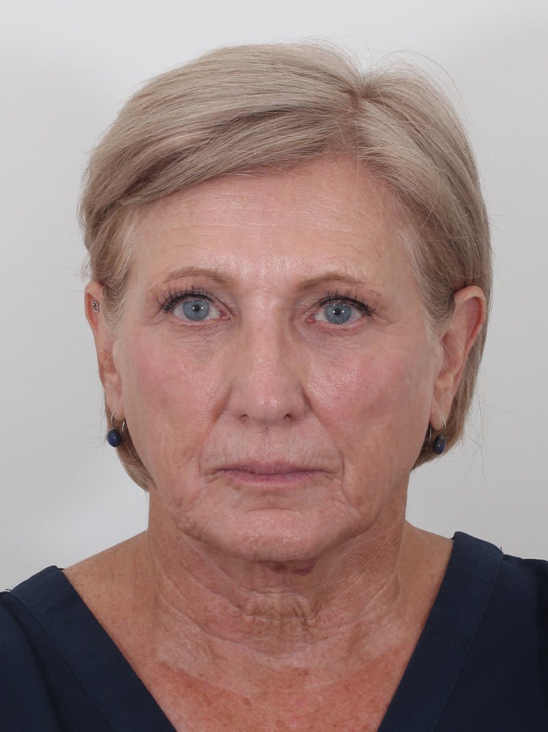 Brow Lift Before & After Gallery - Patient 395143 - Image 1