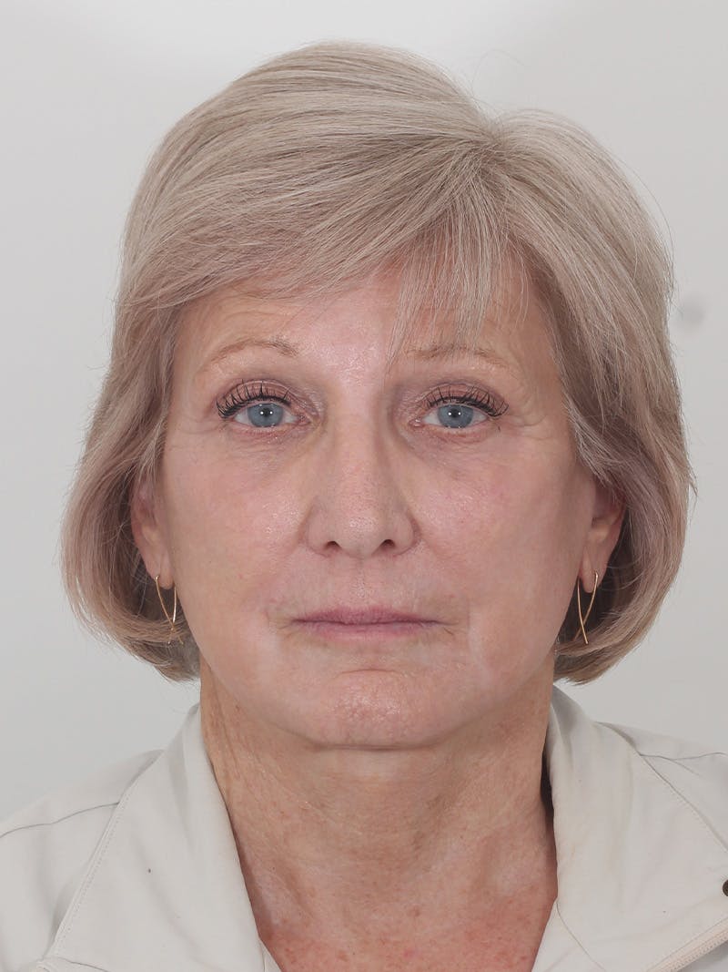 Brow Lift Before & After Gallery - Patient 395143 - Image 2